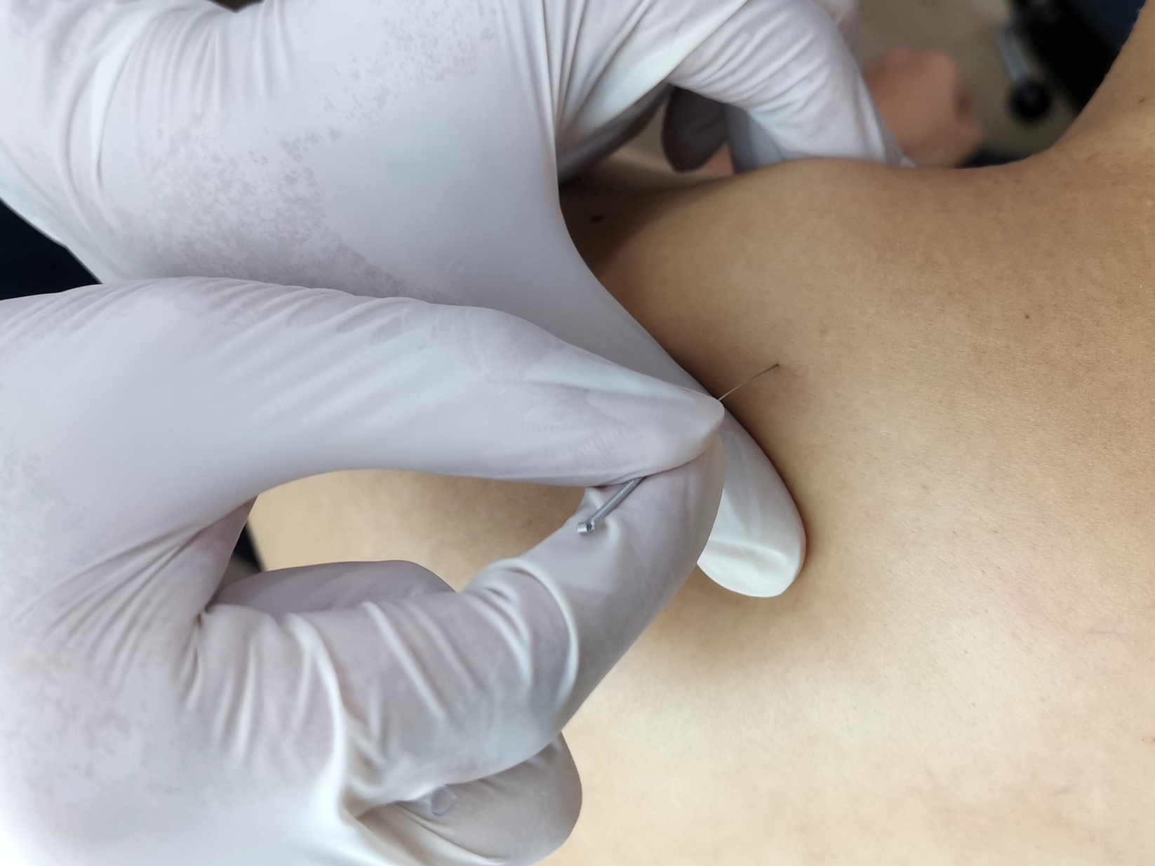 Dry Needling